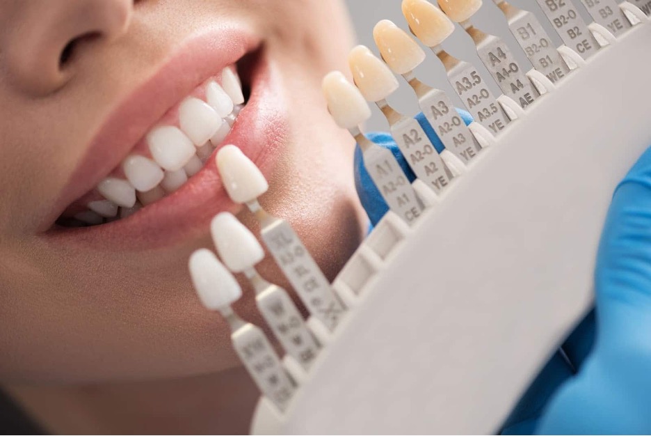How to match natural shade of tooth for Zirconia crown